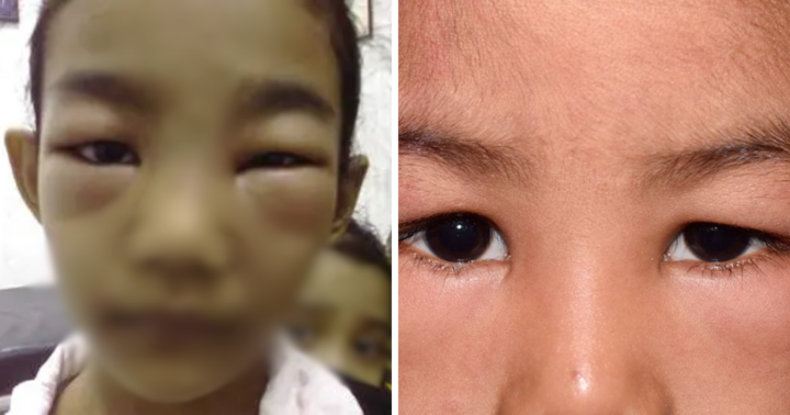Cảnh báo hội chứng thận hư ở trẻ em, mức độ nguy hiểm đến tính mạng như thế nào?