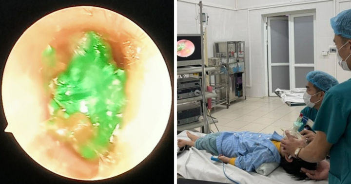 Gắp dị vật là sáp màu trong tai bé trai do bạn nhét vào khi chơi đùa