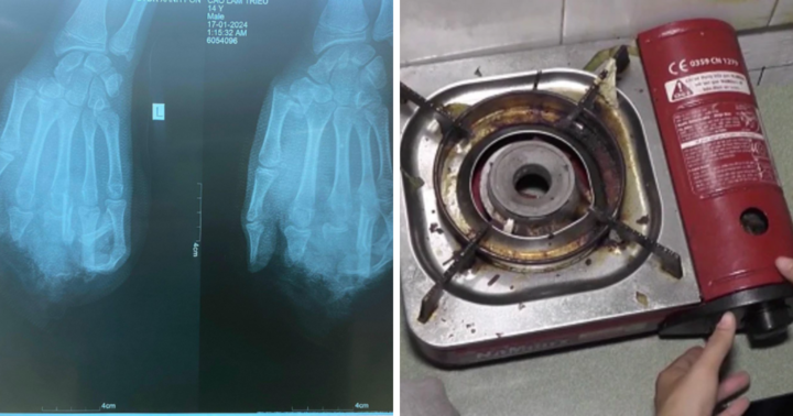 Nam sinh gặp tai nạn trong lúc đang ăn lẩu bằng bếp gas mini