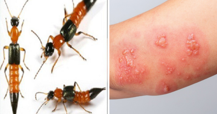 Cô gái 29 tuổi sốc phản vệ mức độ nặng vì kiến ba khoang đốt 