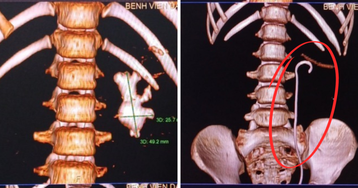 Sỏi thận tái phát, bệnh nhi 9 tuổi được phẫu thuật sau 3 lần mổ trước đó