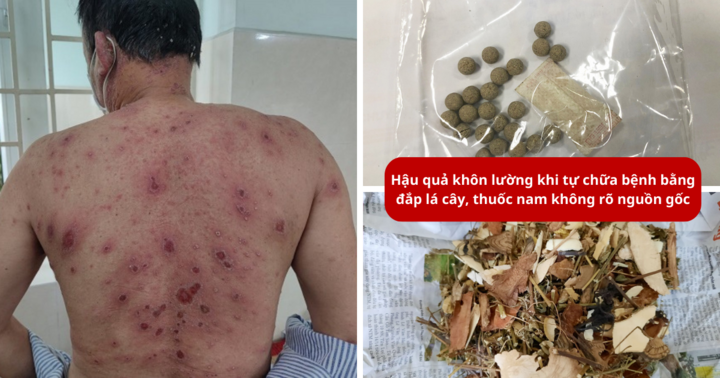Rùng mình hậu quả tự chữa bệnh bằng đắp lá cây, thuốc nam không rõ nguồn gốc