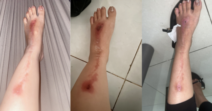 Tham gia tiệc cuối năm, người phụ nữ bị bỏng vì tiết mục bắn pháo hoa