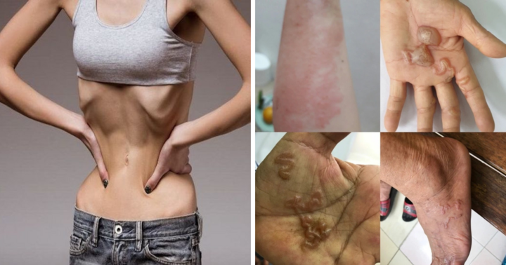 Cẩn trọng với những dấu hiệu nghi nhiễm ký sinh trùng