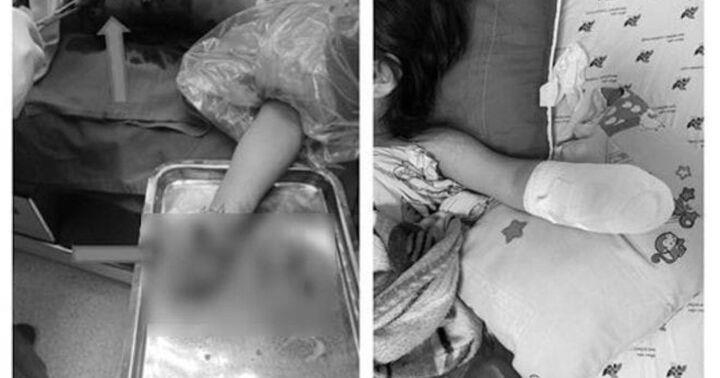 Bé 5 tuổi mất bàn tay trái vì nhặt một viên pháo nổ trên sân