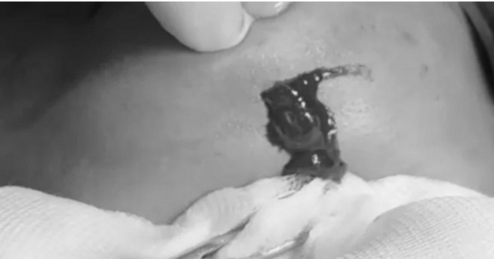 Người phụ nữ bị áp xe cằm sau tiêm filler làm đẹp tại spa