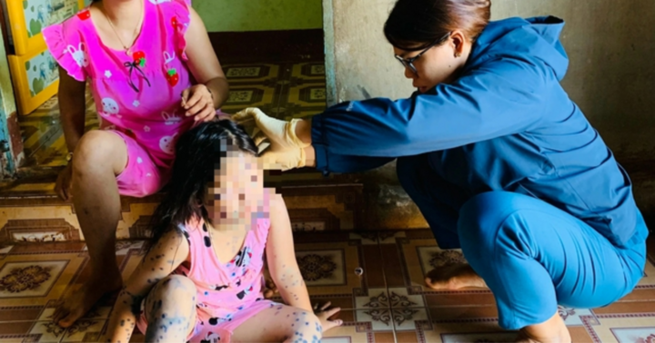 Xuất hiện 3 ổ dịch thủy đậu tại các trường mầm non ở Đắk Lắk