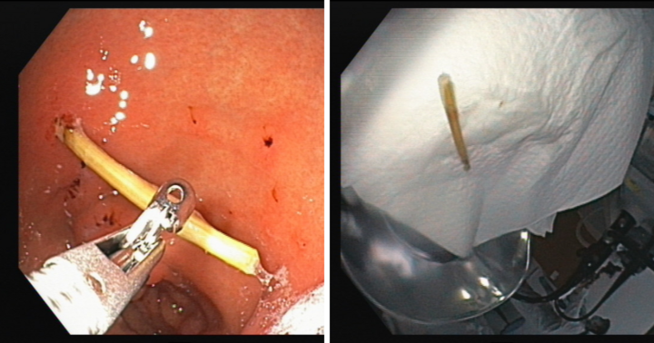 Người đàn ông gặp nguy hiểm vì dị vật bên trong món bò lá lốt