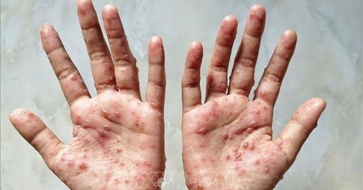 Phát hiện ca bệnh đầu tiên nghi mắc đậu mùa khỉ tại Cà Mau
