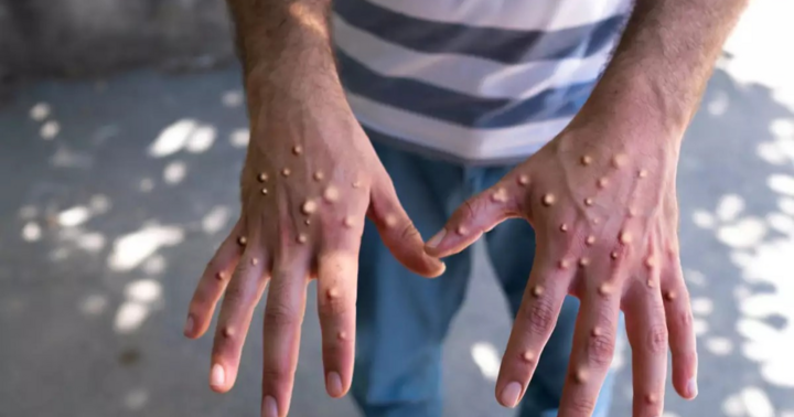 Chủ tịch UBND tỉnh Cà Mau yêu cầu phòng dịch sau ca nghi mắc đậu mùa khỉ