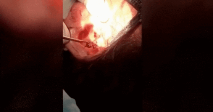 Video: Bác sĩ sốc khi phát hiện thứ  "ngọ nguậy " trong tai cô gái