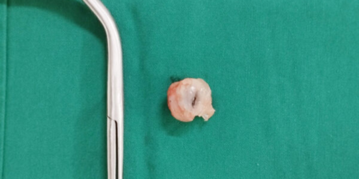 Bé 5 tuổi suy hô hấp nặng do hóc quả nhãn