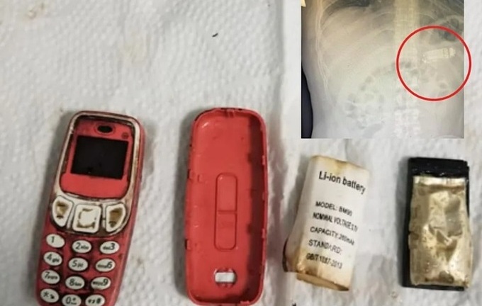 Phẫu thuật lấy thành công điện thoại di động khỏi dạ dày của một tù nhân