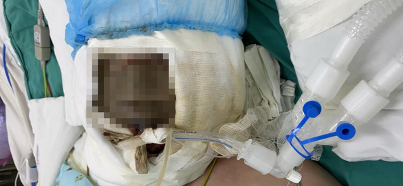 Ngã vào nồi nước xông phòng COVID-19, bé gái 14 tuổi bị bỏng nguy kịch