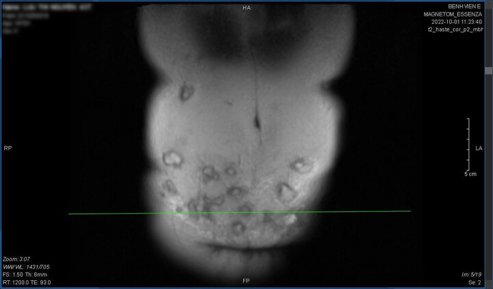 Người phụ nữ bị hoại tử vùng bụng sau khi tiêm tan mỡ tại spa