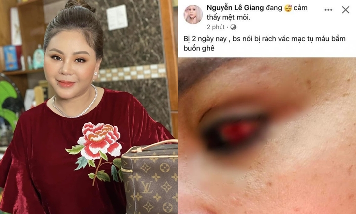 Nghệ sĩ Lê Giang bị rách giác mạc, phải ngừng công việc để điều trị