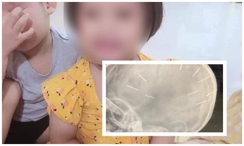 Vụ bé gái nghi bị ghim đinh ở Hà Nội: Nạn nhân đặc biệt sợ mẹ và người tình