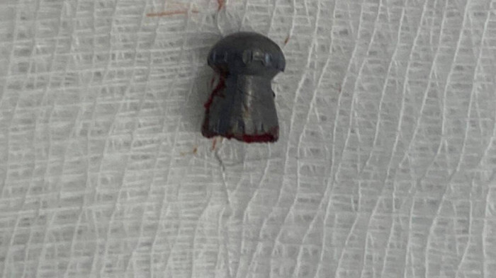 Cần Thơ: Đang ngoài đồng, nam thanh niên bị đạn lạc xuyên vùng kín