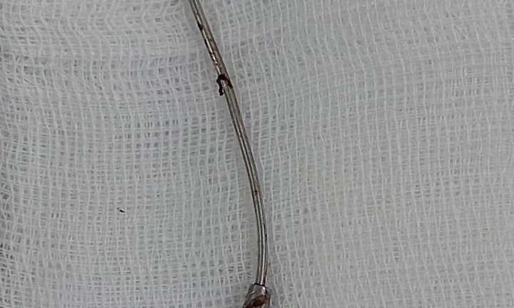 Bé gái bị que kim loại xuyên thẳng vào tai vì bất cẩn