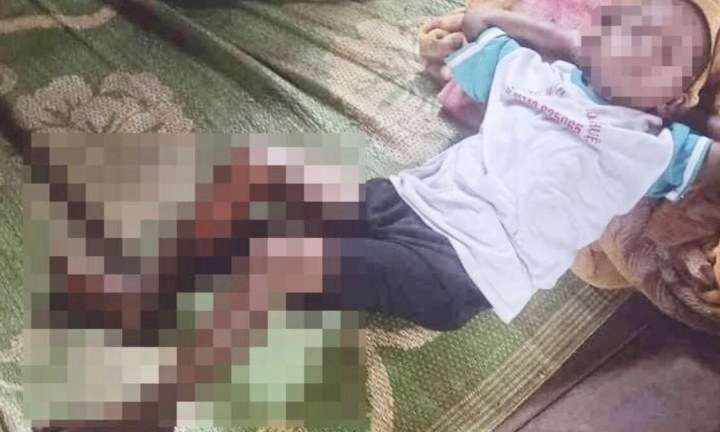 Vụ bé trai 8 tuổi ở Đắk Lắk bị đốt bỏng chân: Công an thông tin ban đầu