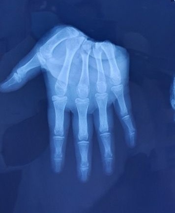 Vụ bé trai 12 tuổi bị chém lìa bàn tay phải ở TP.HCM: Sức khỏe giờ ra sao?