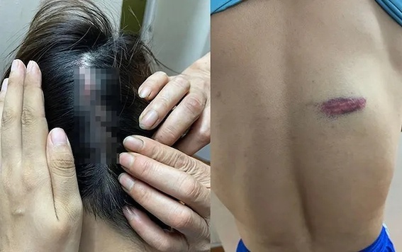 Điều tra vụ vận động viên đấu kiếm bị đồng đội hành hung nhập viện