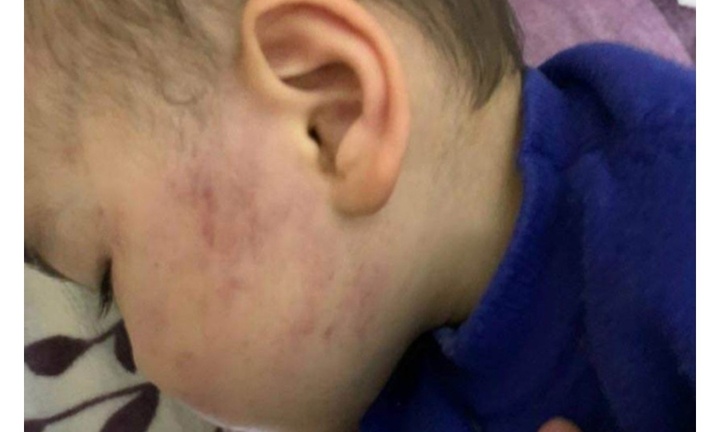 Bé trai 2 tuổi bị tát sưng một bên má ở Thái Bình: Cô giáo nói bé 