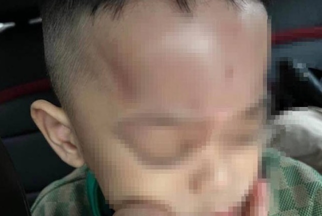 Nghi án bé 4 tuổi bị bạo hành tại trường mầm non ở Đà Nẵng
