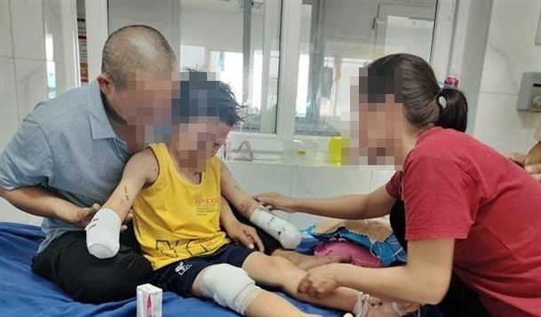 Vụ nghi nổ pháo tự chế ở Đắk Lắk: Bé trai bị đứt lìa hai bàn tay, khóc liên tục 20 tiếng/ngày 