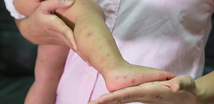 Tin thời sự mới nóng nhất ngày 10/7: Không để thiếu thuốc điều trị bệnh tay chân miệng