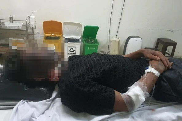 Hai thanh niên đi kích cá đêm bị sét đánh trúng, nhập viện cấp cứu