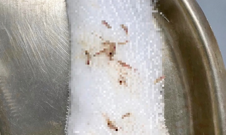 Kinh hoàng phát hiện 20 con giòi làm tổ trong tai bé gái 2 tuổi