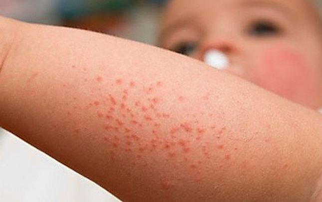 TP.HCM: Sốt xuất huyết tiếp tục leo thang, thêm 111 ổ dịch mới