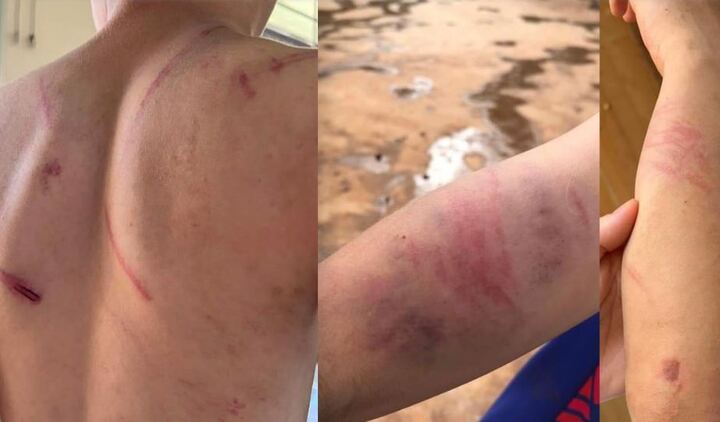 Vụ bé trai 9 tuổi nghi bị bố ruột đánh đập dã man ở Đắk Lắk: Sức khỏe nạn nhân ra sao?