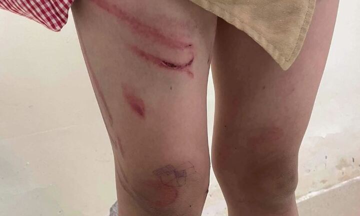 Hải Phòng: Bé trai 8 tuổi nghi bị cha dượng 