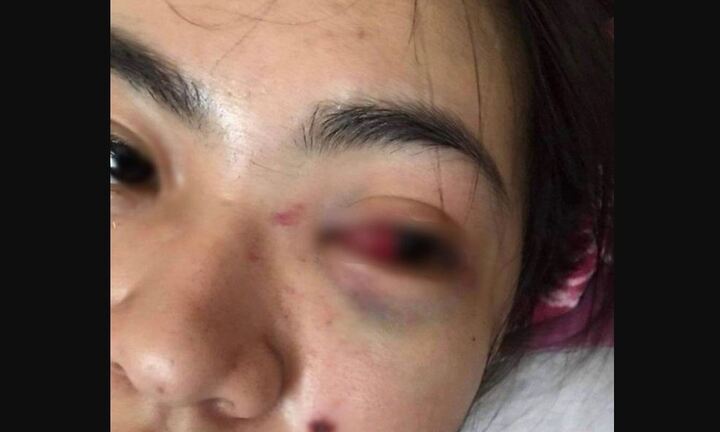 Nữ sinh lớp 11 bị đánh hội đồng tụ máu mắt: Mâu thuẫn từ việc chấm điểm thi đua