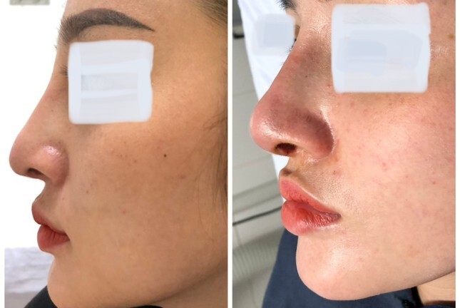 Cô gái bị nhiễm trùng, lộ sống mũi sau khi nâng mũi 6 tháng