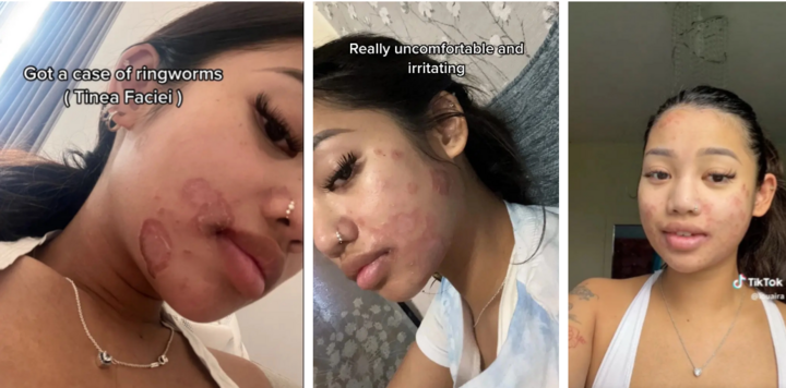 Cô gái nhiễm giun đũa khắp mặt, nguyên nhân khiến nhiều chị em bất ngờ