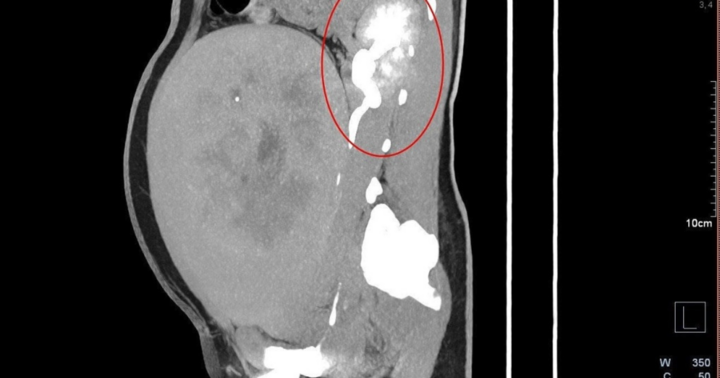 Người phụ nữ 39 tuổi phát hiện khối u xơ tử cung to như mang thai 8 tháng