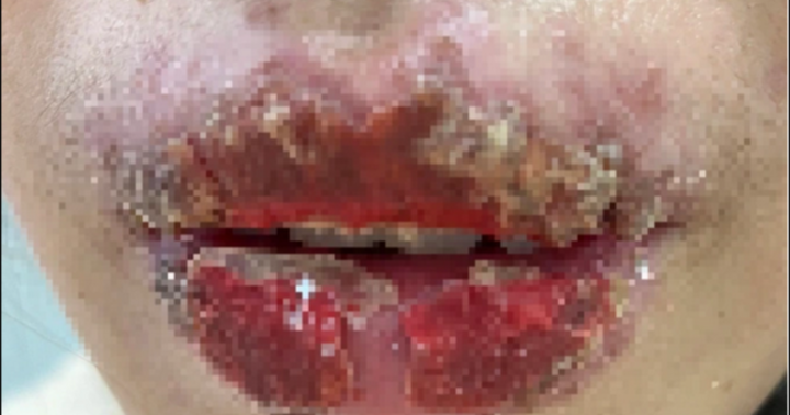 Hà Nội: Nữ sinh lớp 10 mưng mủ, đóng vảy ở môi sau khi cùng chị đi xăm