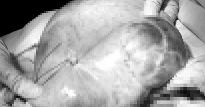 Cắt bỏ khối u buồng trứng nặng 5kg cho bệnh nhân 50 tuổi