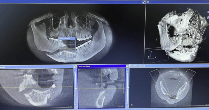 Cúi người vào thang máy đang sửa để nhặt điện thoại, nam thanh niên mất toàn bộ hàm răng