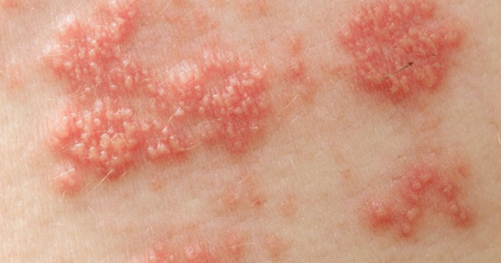 Cảnh báo: Biến chứng nguy hiểm từ Zona thần kinh