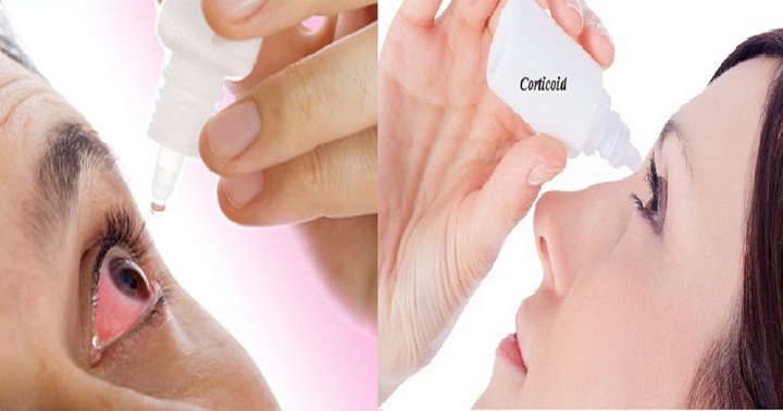 Tuyệt đối không tự ý sử dụng thuốc nhỏ mắt có chứa corticoid để điều trị bệnh đau mắt đỏ