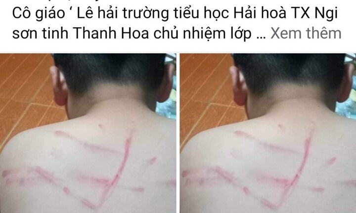 Xác minh làm rõ vụ học sinh lớp 4 bị cô giáo đánh bầm tím vì không làm bài tập