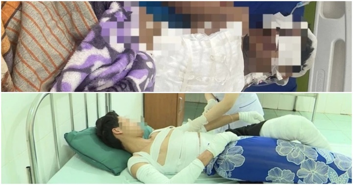 Liên tiếp xảy ra các trường hợp dập nát bàn tay, đa chấn thương do tự chế pháo nổ ở Đắk Nông