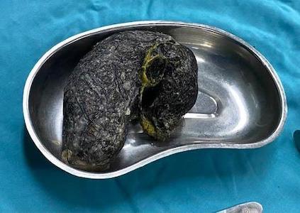  Phẫu thuật lấy gần nửa kg tóc trong dạ dày bé gái 7 tuổi