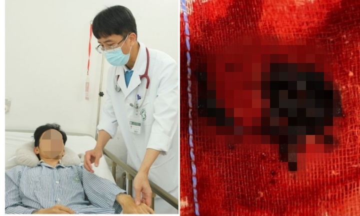 6 ca đột quỵ cấp cứu chỉ trong một đêm, tất cả là người trẻ tuổi