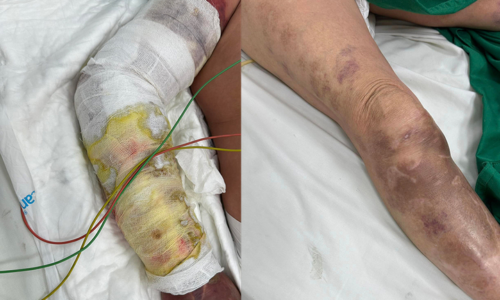 Người phụ nữ nguy kịch vì ngạnh cá trê đâm vào tay