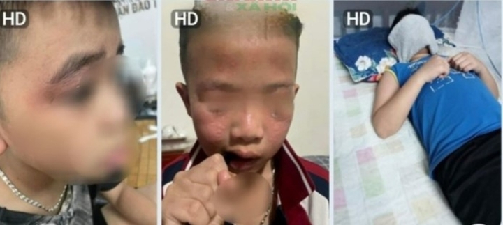 Lãnh đạo trường nói gì khi loạt học sinh dị ứng, sưng mắt ngay đầu tuần?